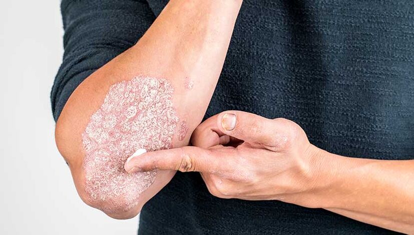 conas psoriasis a chóireáil