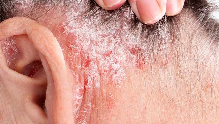 psoriasis seborrheic ar an scalp