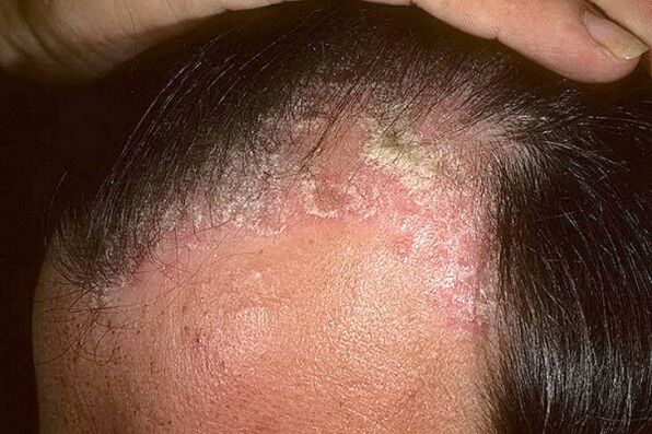 Comharthaí psoriasis