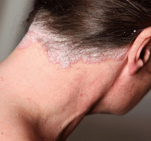Conas psoriasis a chóireáil