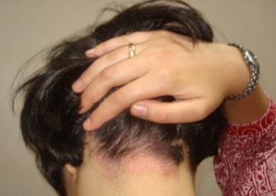 Psoriasis ar an gceann