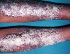 Ointment ó psoriasis