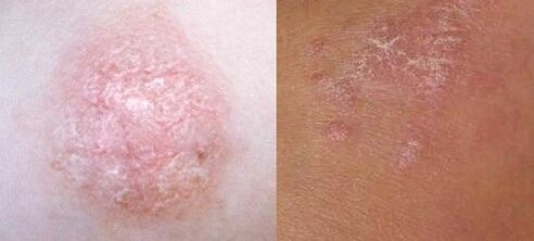 Psoriasis ag an gcéad chéim